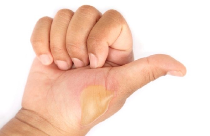 Najveća greška koju pravite kada se opečete