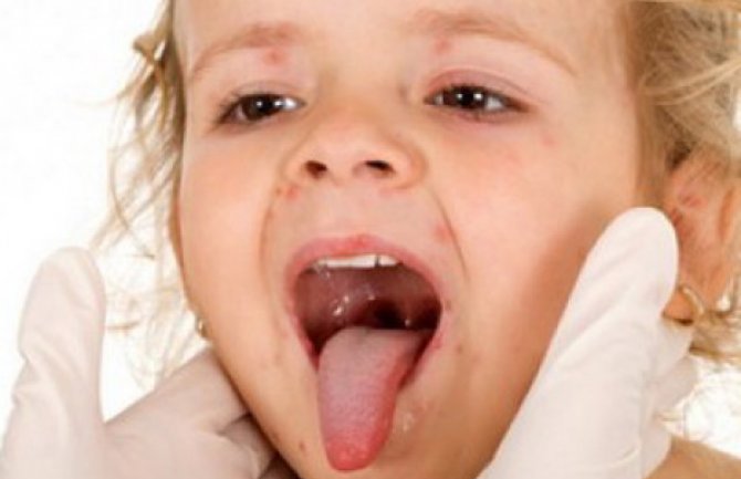 Na Kosovu smanjena epidemija malih boginja